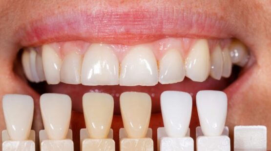 Dental-Laminates-Porcelain-Veneer