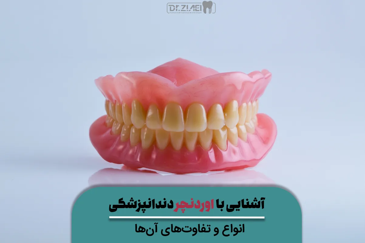 انواع اوردنچر دندانپزشکی