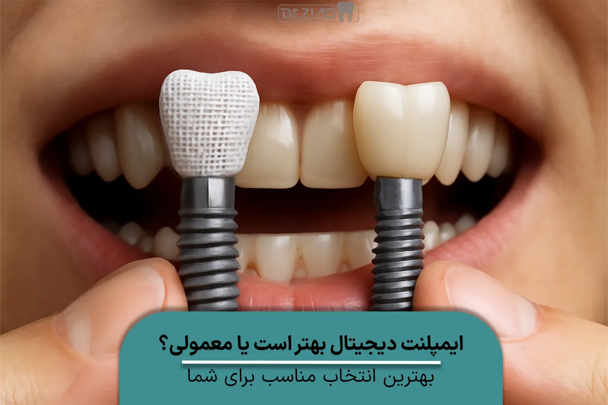 ایمپلنت دیجیتال بهتر است یا معمولی؟