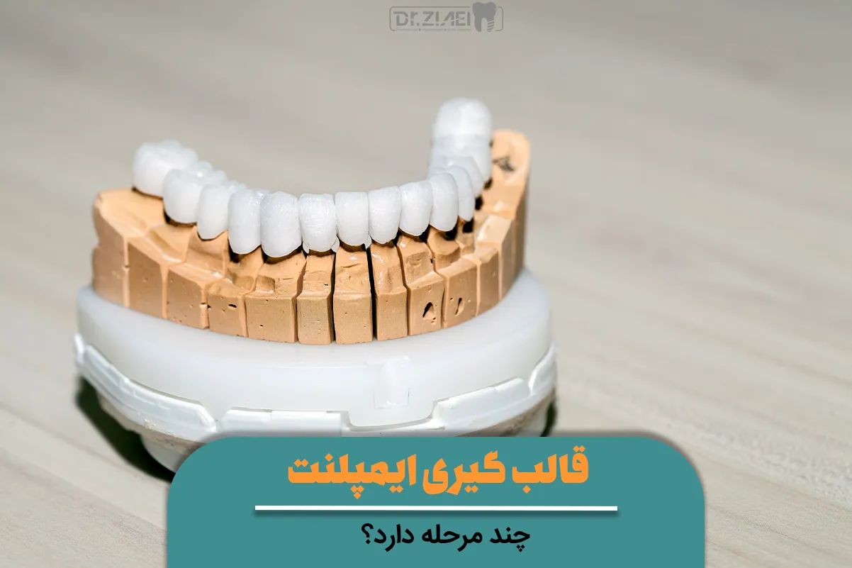 قالب گیری ایمپلنت چند مرحله دارد؟