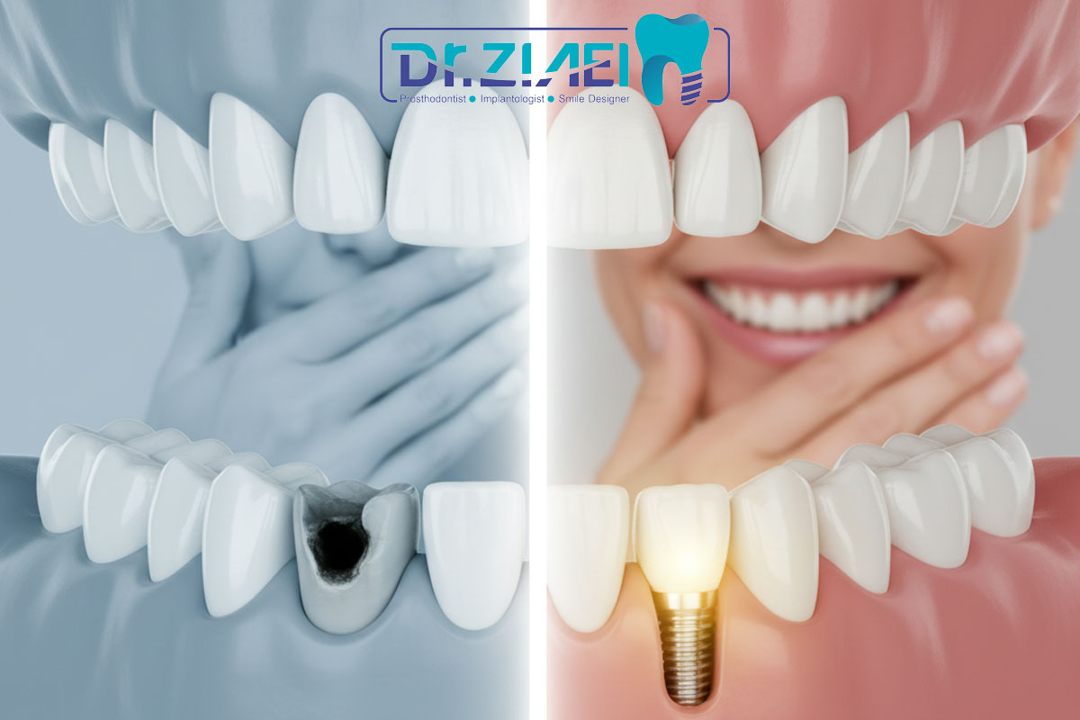 ایمپلنت دندان: راه‌حل دائمی برای دندان‌های پوسیده و از دست رفته