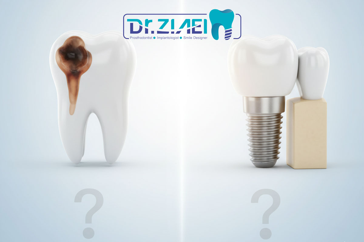 ایمپلنت دندان: آیا راه‌حل مناسب برای دندان‌های پوسیده شماست؟