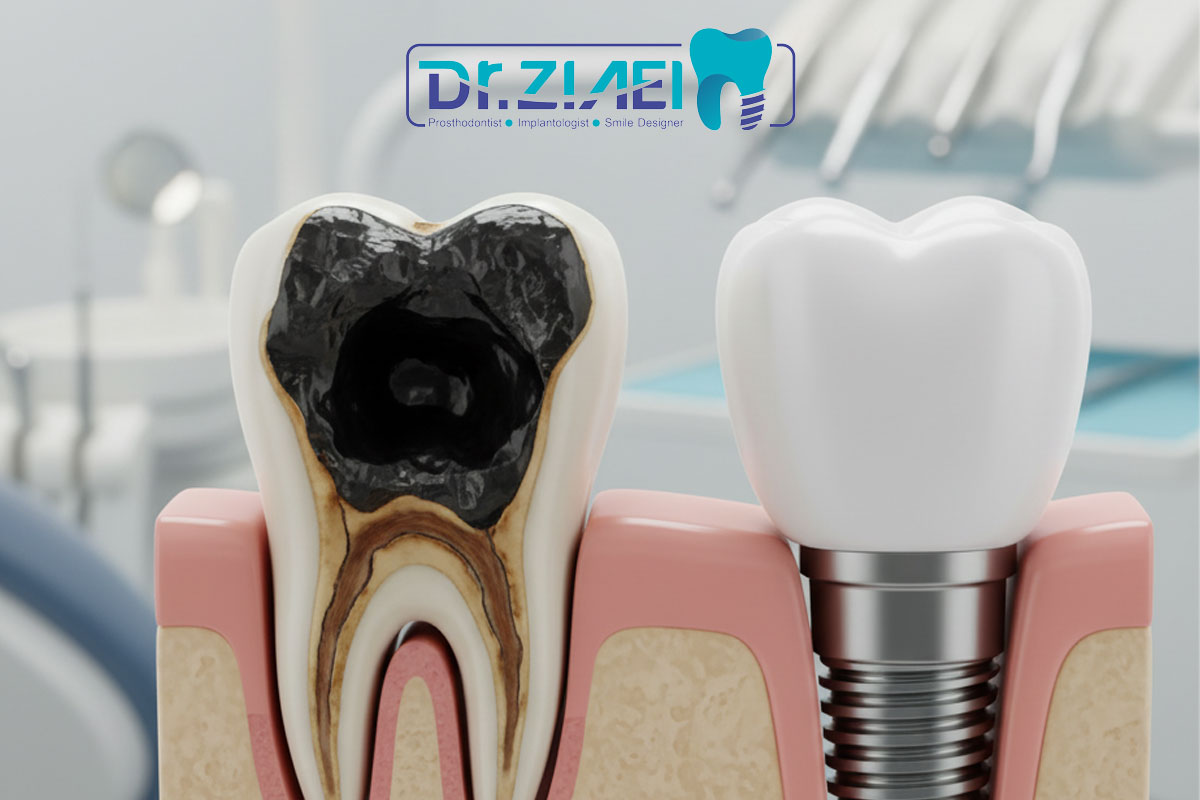 وقتی دندان پوسیده قابل ترمیم نیست