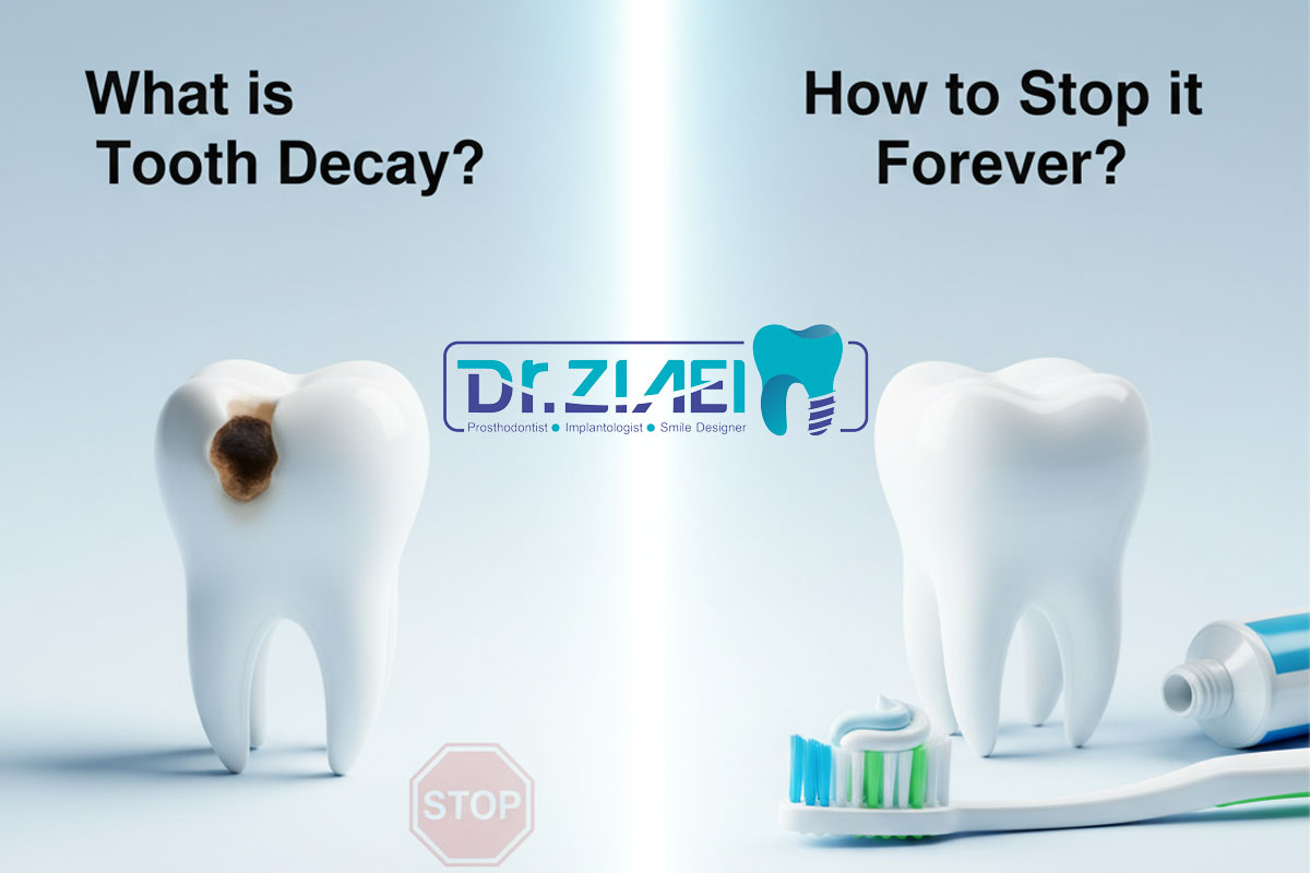 پوسیدگی دندان چیست و چگونه میتوان آن را برای همیشه متوقف کرد؟